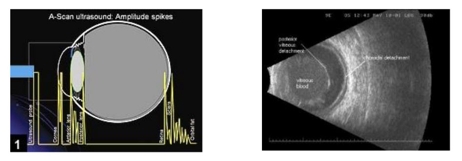 Figura 4.1. Ecogramas en Modo-A (izquierda) y en Modo-B (derecha).