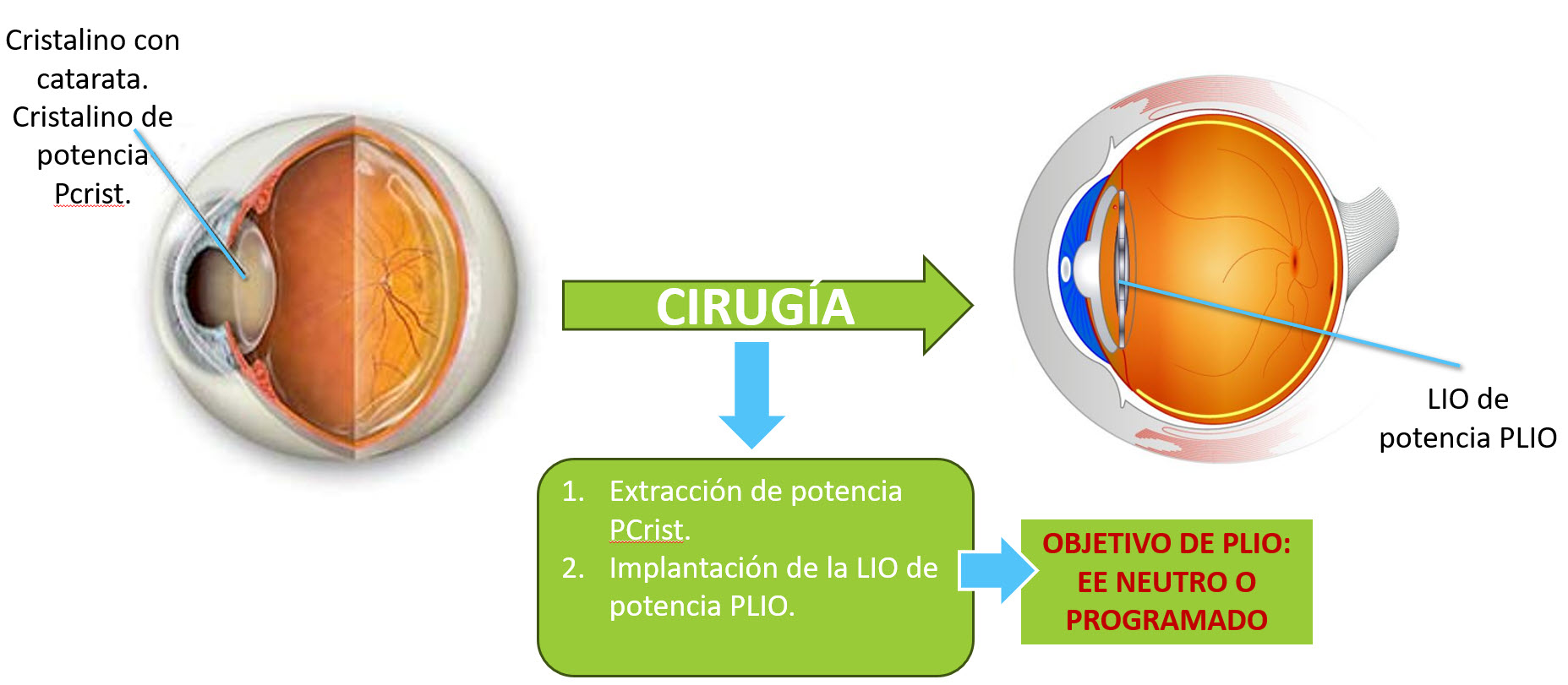 Del ojo fáquico al pseudofáquico a través de la cirugía